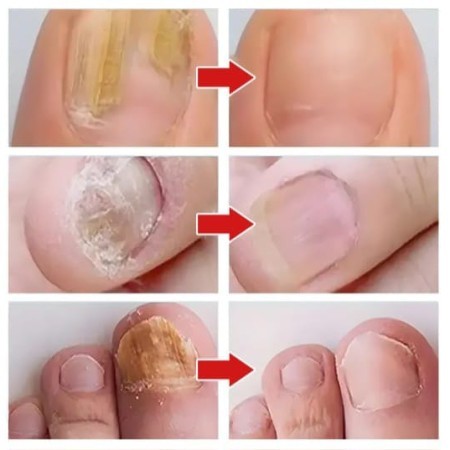 Nail fungus sprey( নখের ফাংগাশ স্প্রে)