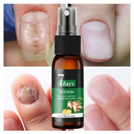 Nail fungus sprey( নখের ফাংগাশ স্প্রে)