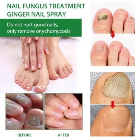 Nail fungus sprey( নখের ফাংগাশ স্প্রে)